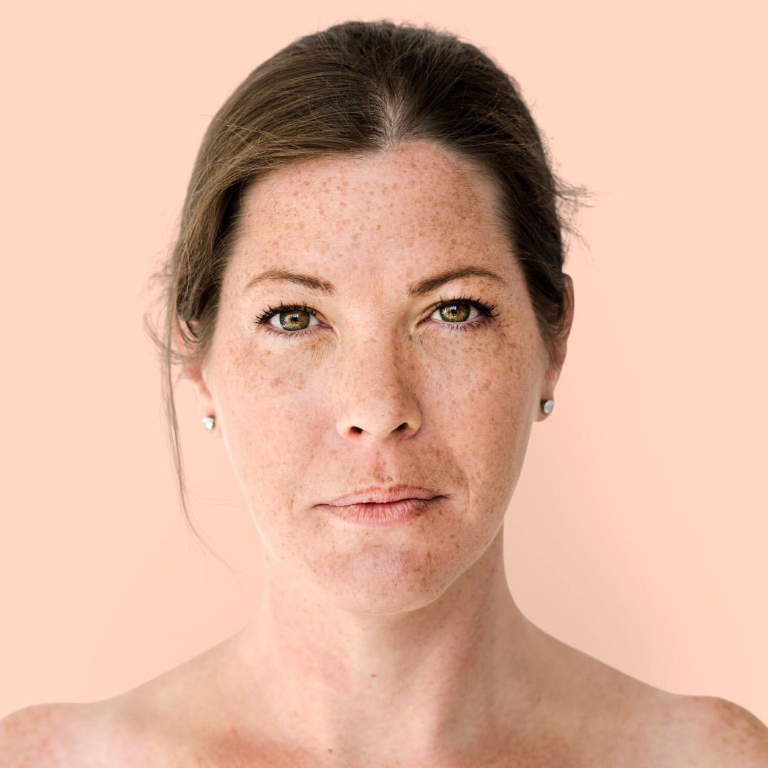 Acne scarring
