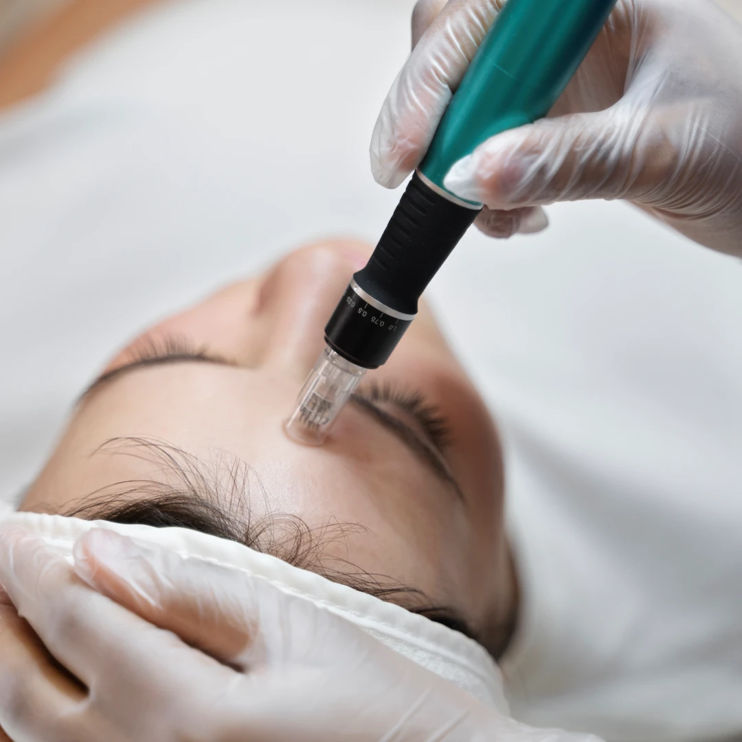 microneedling with SkinPen
